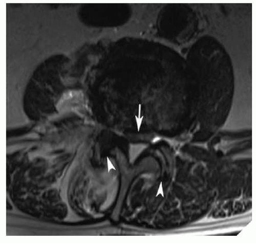 Biomechanics Of Aging Spine | Musculoskeletal Key