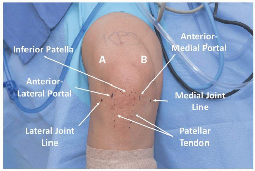 Principles Of Knee Arthroscopy | Musculoskeletal Key