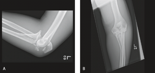 ORIF For Olecranon Fractures: Simple Olecranon Fractures ...