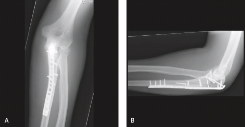 ORIF For Olecranon Fractures: Simple Olecranon Fractures ...