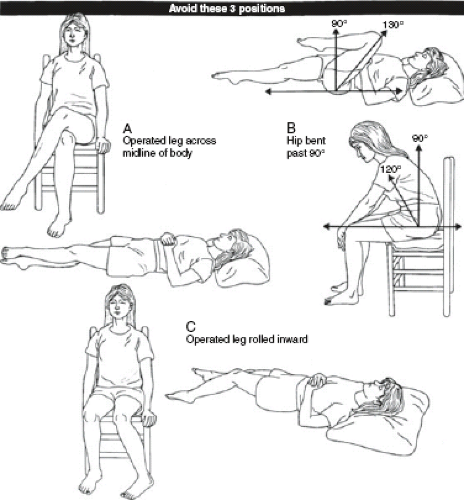 Revision Total Hip Arthroplasty | Musculoskeletal Key