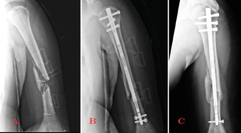 The Future Of Intramedullary Limb Lengthening | Musculoskeletal Key