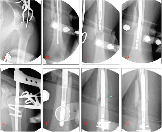 The Future Of Intramedullary Limb Lengthening | Musculoskeletal Key