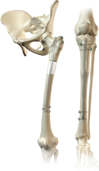 Intramedullary Lengthening Devices | Musculoskeletal Key