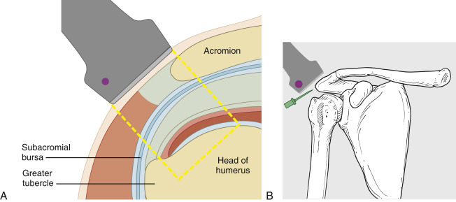 Greater Trochanteric Bursa/Gluteus Medius Injection: Ultrasound ...