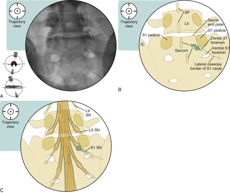 S1 Transforaminal Epidural Steroid Injection | Musculoskeletal Key