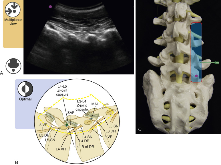 Greater Trochanteric Bursa/Gluteus Medius Injection: Ultrasound ...