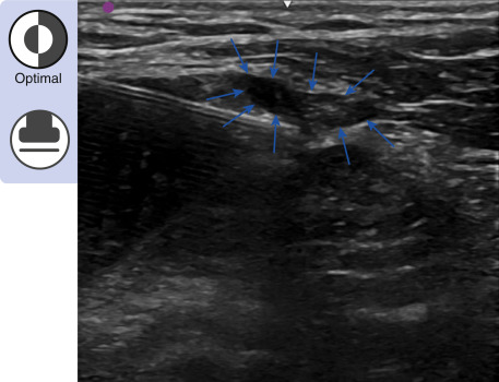 Greater Trochanteric Bursa/Gluteus Medius Injection: Ultrasound ...