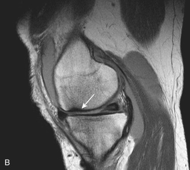 CLINICAL MRI OF OSTEOARTHRITIS AND OSTEOCHONDRAL INJURY ...