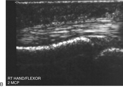 ULTRASOUND EVALUATION OF RHEUMATOID ARTHRITIS | Musculoskeletal Key