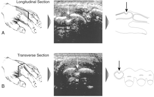 ULTRASOUND EVALUATION OF RHEUMATOID ARTHRITIS | Musculoskeletal Key