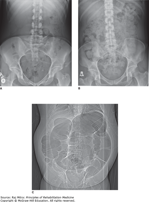 Assessment Of The Bladder And Bowel Dysfunction For The Rehabilitation ...