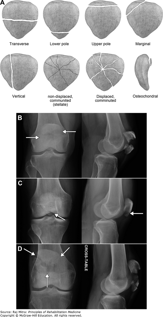 Rehabilitation Of Lower Extremity Injuries | Musculoskeletal Key