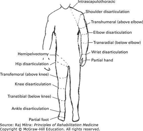 Issues In Pediatric Amputations | Musculoskeletal Key