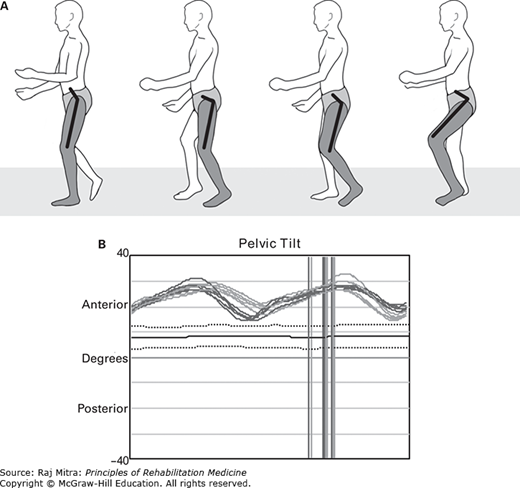 Gait Evaluation And Management | Musculoskeletal Key