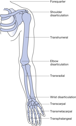 Rehabilitation And Prosthetic Restoration In Upper Limb Amputation | Musculoskeletal Key