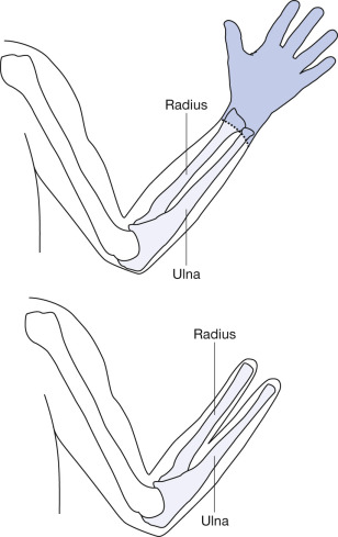 Rehabilitation And Prosthetic Restoration In Upper Limb Amputation ...