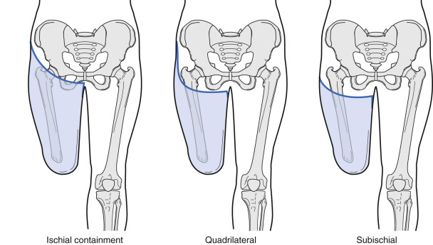 Lower Limb Amputation And Gait | Musculoskeletal Key