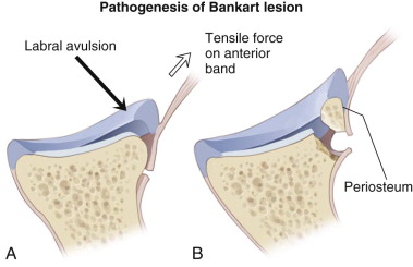 Anterior Shoulder Instability | Musculoskeletal Key