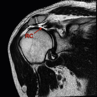 Rotator Cuff Augmentation | Musculoskeletal Key