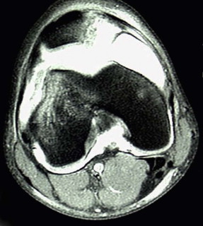 Patellar Instability | Musculoskeletal Key