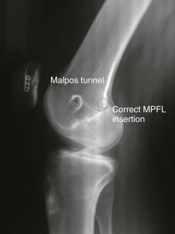 Patellar Instability | Musculoskeletal Key