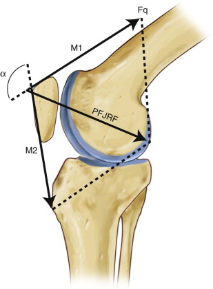 Patellofemoral Pain | Musculoskeletal Key