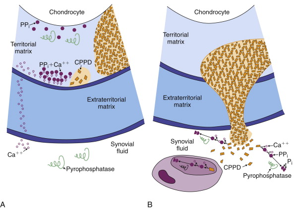 Articular Pathology Of Gout, Calcium Pyrophosphate Dihydrate And Basic ...