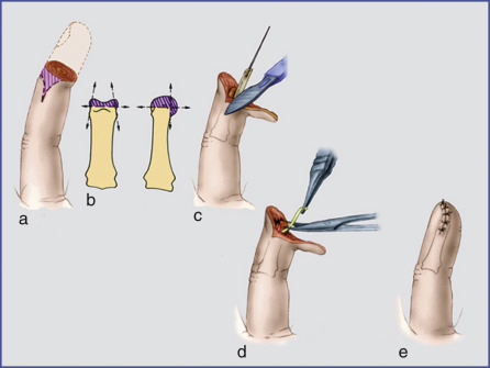 Temporary Amputations And Permanent Amputations | Musculoskeletal Key