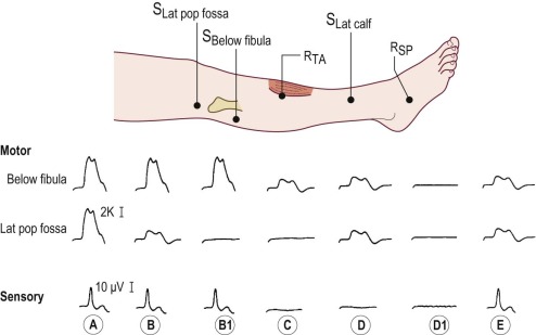 Peroneal Neuropathy | Musculoskeletal Key