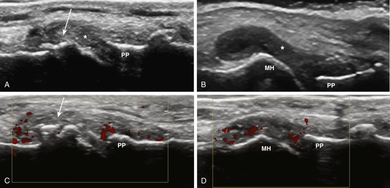 Osteoarthritis | Musculoskeletal Key