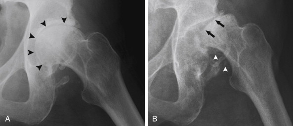 Plain Radiography And Advanced Imaging Of Calcium Pyrophosphate ...