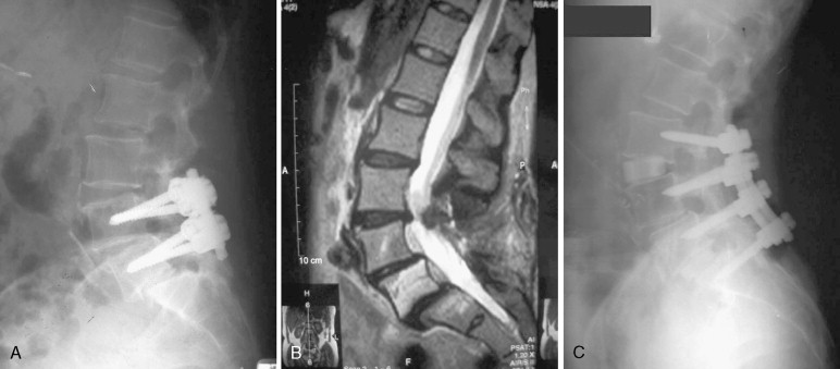 Adjacent-Level Degeneration Of The Lumbar Spine After Lumbar Fusion ...