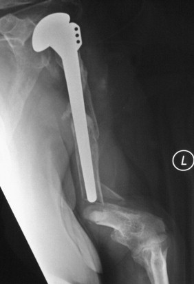 Complications Of Conventional Shoulder Arthroplasty | Musculoskeletal Key