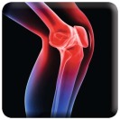 Patellar Instability | Musculoskeletal Key