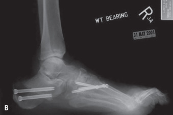 Cavus Foot Correction | Musculoskeletal Key