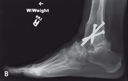 Total Ankle Replacement | Musculoskeletal Key