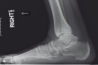 Total Ankle Replacement | Musculoskeletal Key