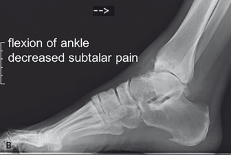 Total Ankle Replacement | Musculoskeletal Key