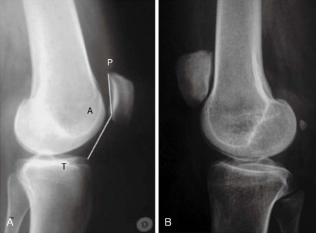 Patellar Instability | Musculoskeletal Key