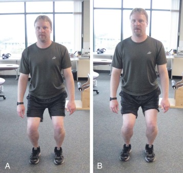 Patellar Instability | Musculoskeletal Key