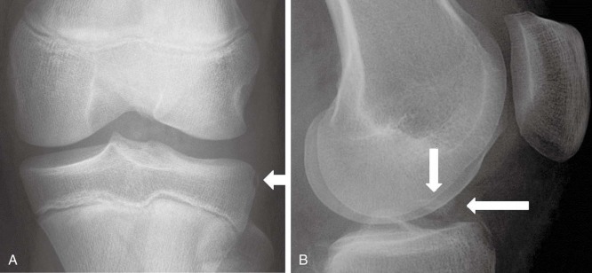 Anterior Cruciate Ligament Injuries | Musculoskeletal Key