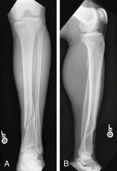 Tibial Shaft Fractures | Musculoskeletal Key