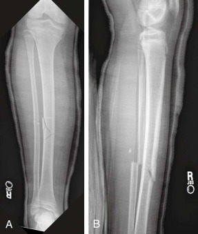 Tibial Shaft Fractures | Musculoskeletal Key