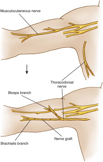 Nerve Transfers | Musculoskeletal Key