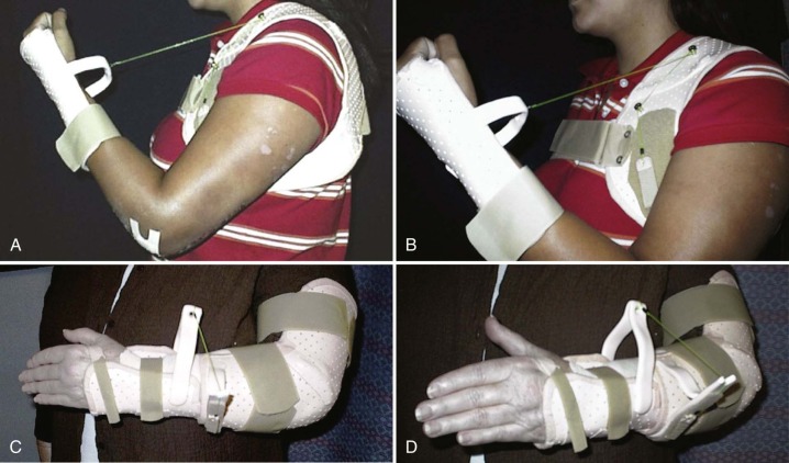 Therapist’s Management Of Fractures And Dislocations Of The Elbow ...