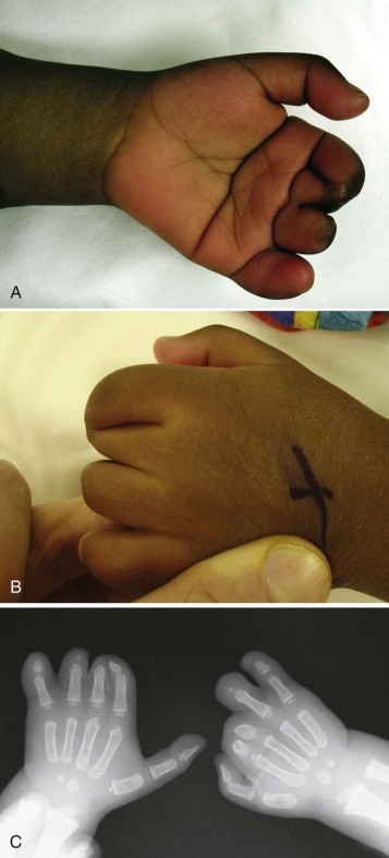 Management Of Congenital Hand Anomalies | Musculoskeletal Key