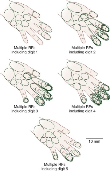 Focal Hand Dystonia | Musculoskeletal Key