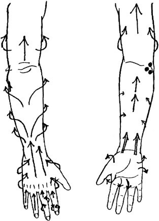 Manual Edema Mobilization: Treatment For Edema In The Subacute Hand ...