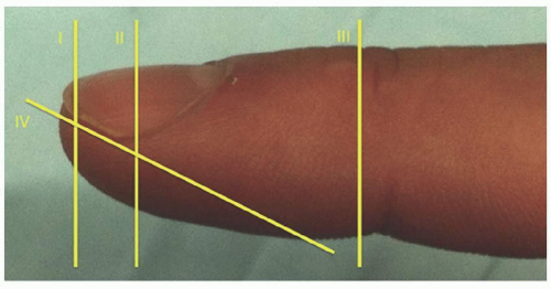 Fingertip Amputations | Musculoskeletal Key